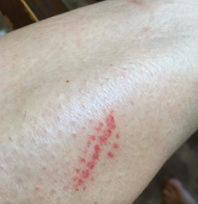 A puss caterpillar left this mark on Crystal Gaston’s leg.